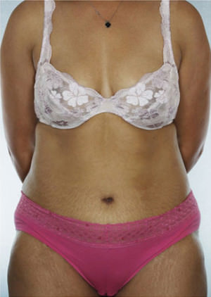 Tummy Tuck Before & After Patient #8048