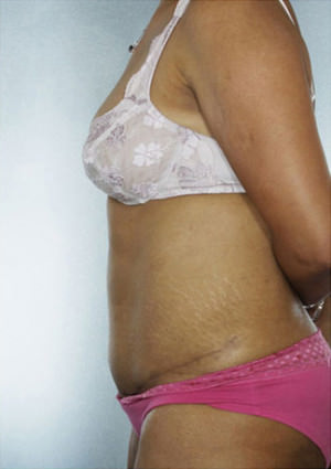 Tummy Tuck Before & After Patient #8048