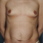 Tummy Tuck Before & After Patient #8053