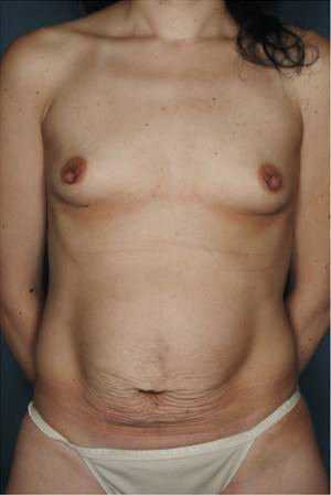 Tummy Tuck Before & After Patient #8053