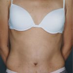 Tummy Tuck Before & After Patient #8053