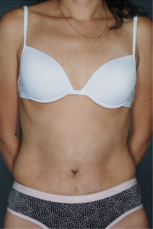 Tummy Tuck Before & After Patient #8053