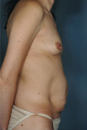 Tummy Tuck Before & After Patient #8053