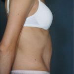 Tummy Tuck Before & After Patient #8053