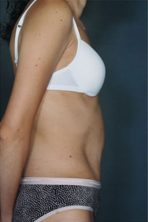 Tummy Tuck Before & After Patient #8053