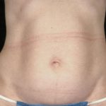 Tummy Tuck Before & After Patient #8058