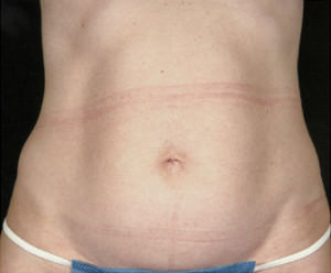 Tummy Tuck Before & After Patient #8058