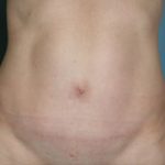 Tummy Tuck Before & After Patient #8058
