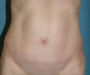 Tummy Tuck Before & After Patient #8058