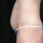 Tummy Tuck Before & After Patient #8058