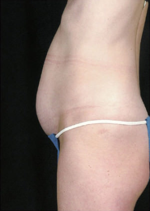 Tummy Tuck Before & After Patient #8058