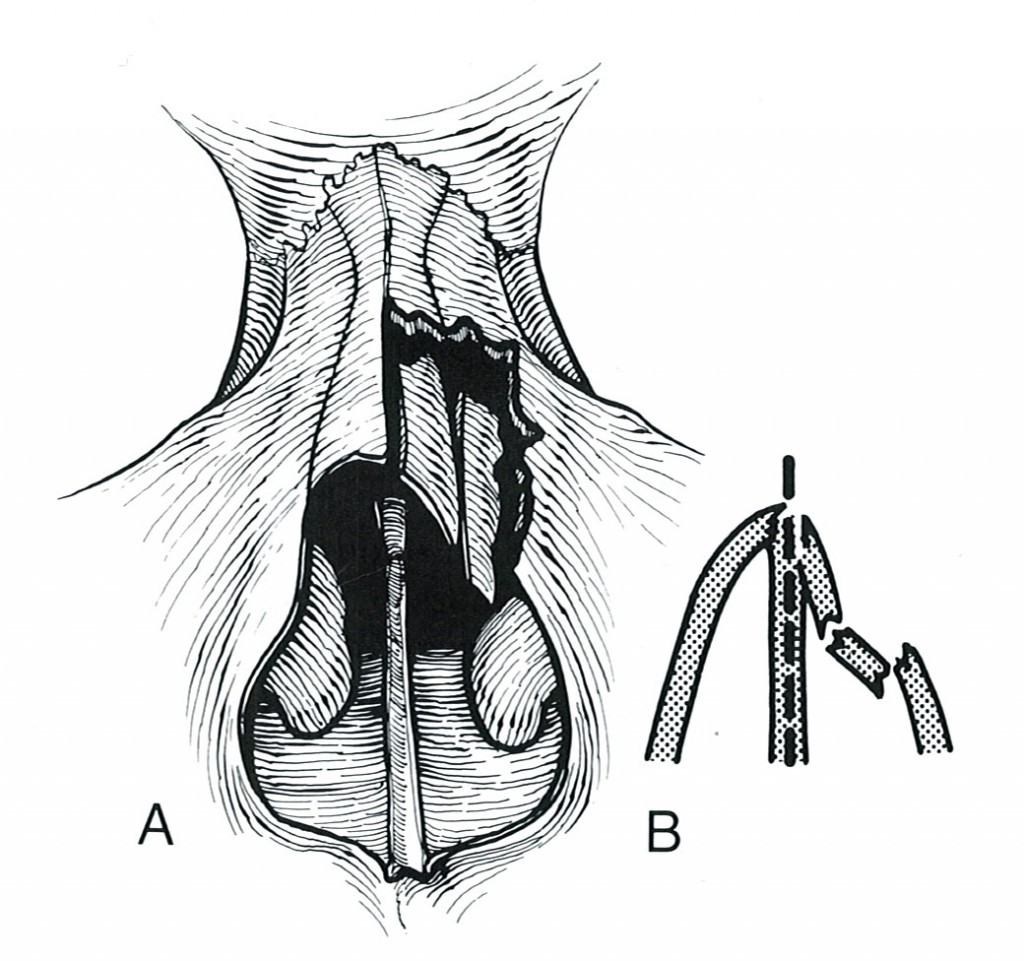 Nasal Fractures Treatment New York