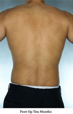 Liposuction Before & After Patient #8659