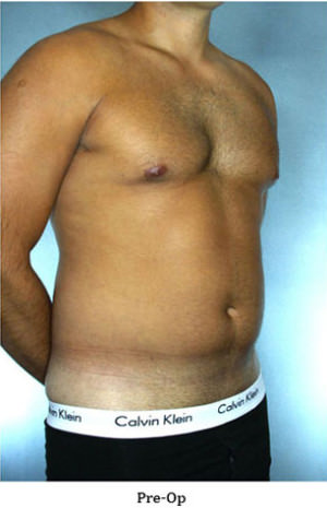 Liposuction Before & After Patient #8659