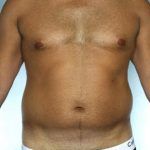 Liposuction Before & After Patient #8659