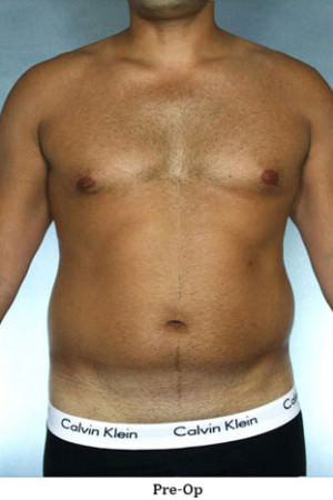 Liposuction Before & After Patient #8659