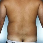 Liposuction Before & After Patient #8659
