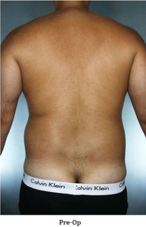 Liposuction Before & After Patient #8659