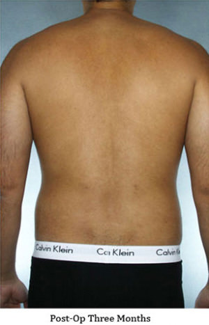 Liposuction Before & After Patient #8659