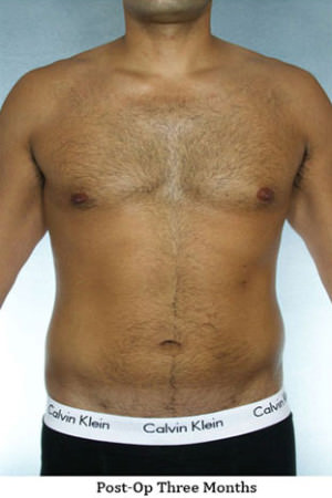 Liposuction Before & After Patient #8659