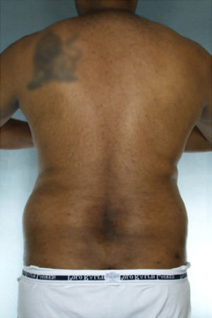 Liposuction Before & After Patient #8683