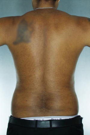 Liposuction Before & After Patient #8683