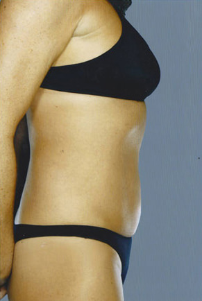 Liposuction Before & After Patient #8617