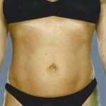 Liposuction Before & After Patient #8617