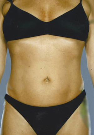 Liposuction Before & After Patient #8617