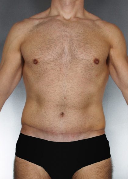 Tummy Tuck Before & After Patient #7940