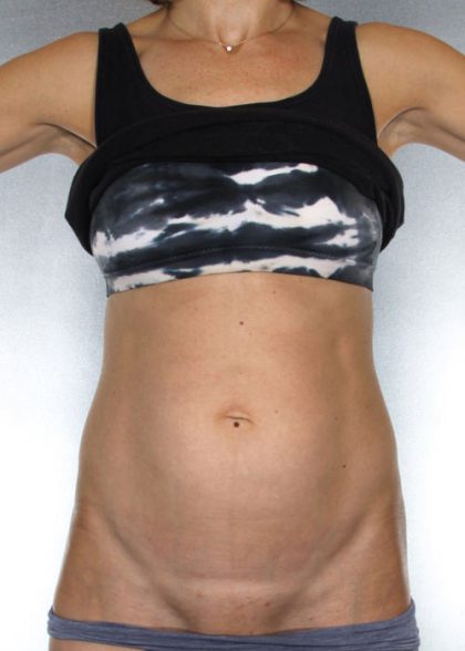 Tummy Tuck Before & After Patient #7955