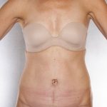 Tummy Tuck Before & After Patient #7955