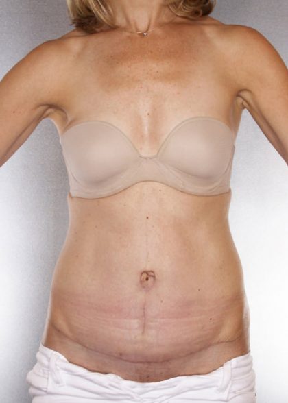 Tummy Tuck Before & After Patient #7955