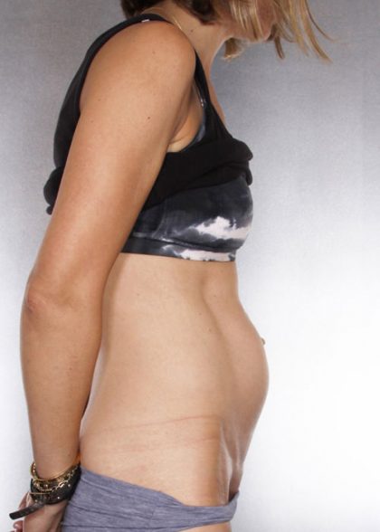 Tummy Tuck Before & After Patient #7955