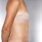 Tummy Tuck Before & After Patient #7955