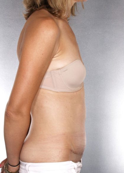 Tummy Tuck Before & After Patient #7955