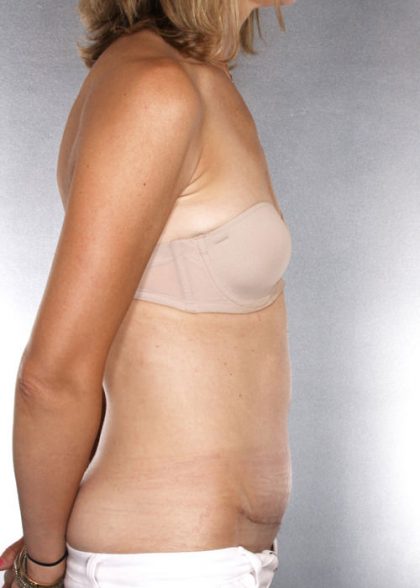 Tummy Tuck Before & After Patient #7955