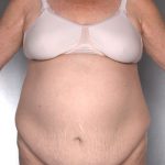 Tummy Tuck Before & After Patient #7960