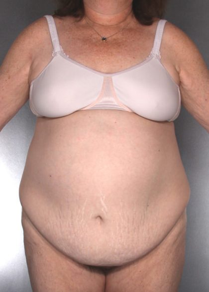 Tummy Tuck Before & After Patient #7960