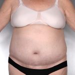 Tummy Tuck Before & After Patient #7960