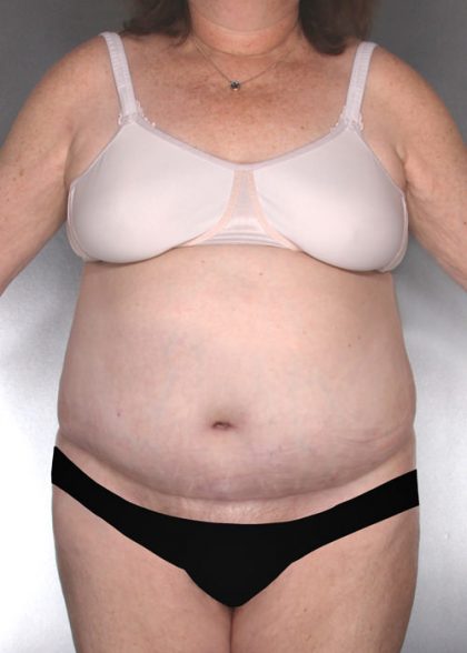 Tummy Tuck Before & After Patient #7960