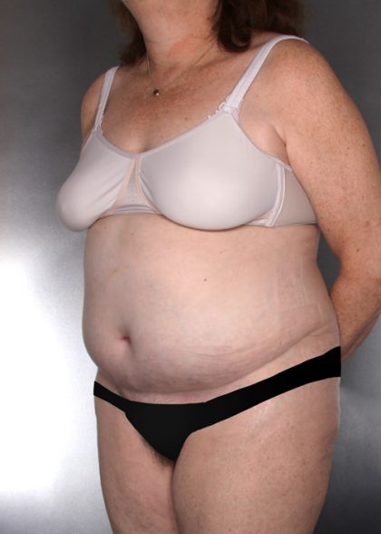 Tummy Tuck Before & After Patient #7960