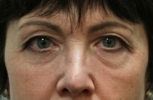 Blepharoplasty Before & After Patient #8886