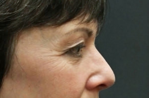 Blepharoplasty Before & After Patient #8886