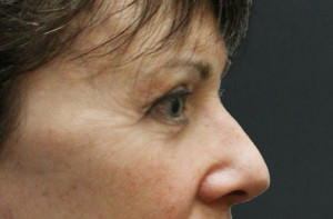 Blepharoplasty Before & After Patient #8886