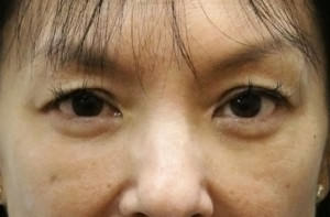 Blepharoplasty Before & After Patient #8891