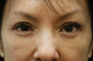 Blepharoplasty Before & After Patient #8891