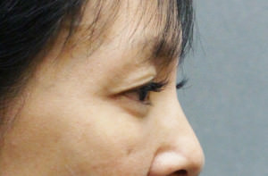 Blepharoplasty Before & After Patient #8891