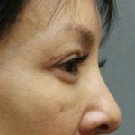 Blepharoplasty Before & After Patient #8891