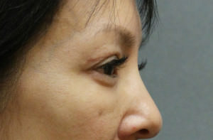 Blepharoplasty Before & After Patient #8891